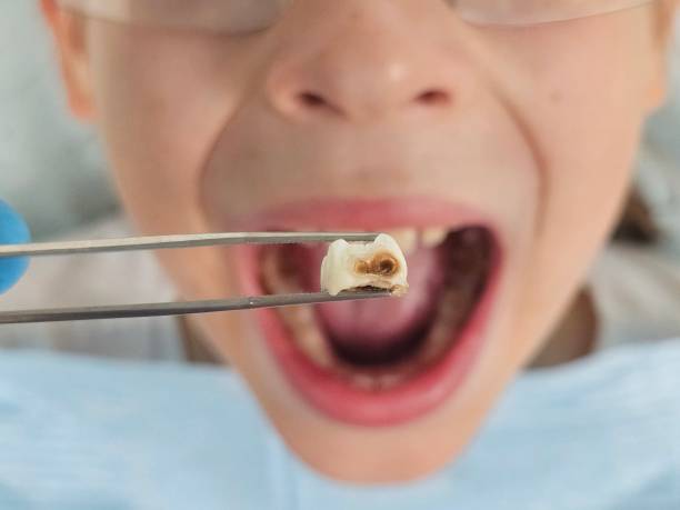 Best Cracked Tooth Emergency Dentist  in Pleasantdale, NJ
